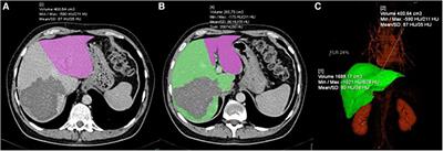 Correlation between the liver transection line localization and future liver remnant hypertrophy in associating liver partition and portal vein ligation for staged hepatectomy